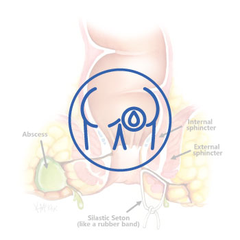 Anal Fistula Abu Dhabi