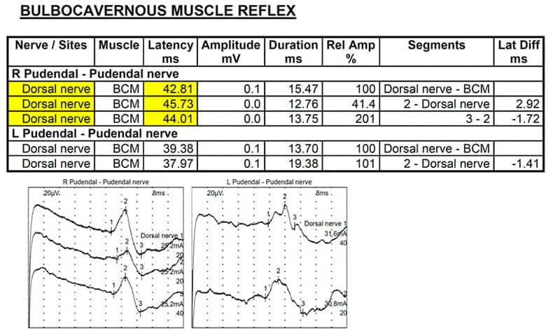 bulbo cavernous muscle 