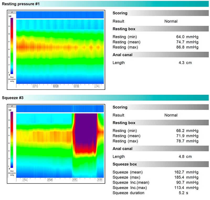 Anal Pain anoreactal manometry